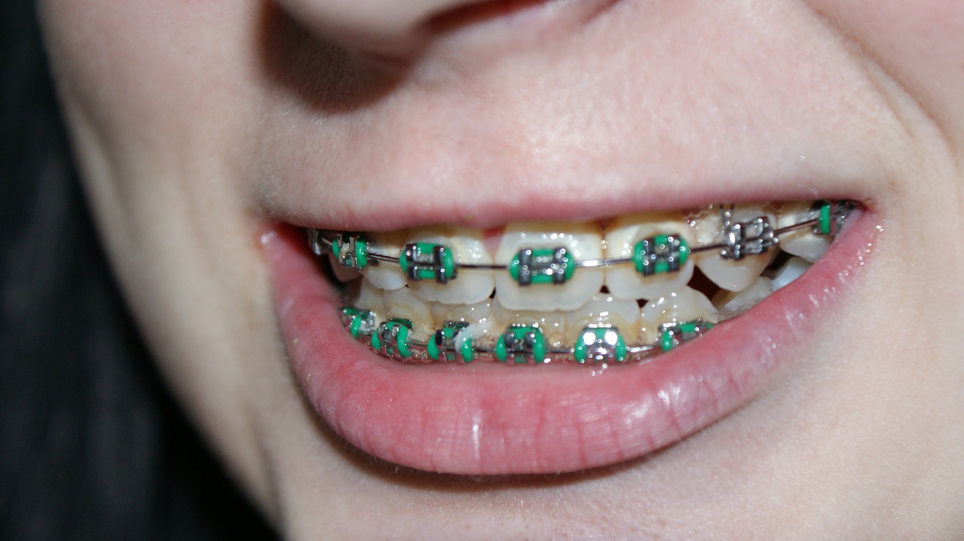 Living with your braces